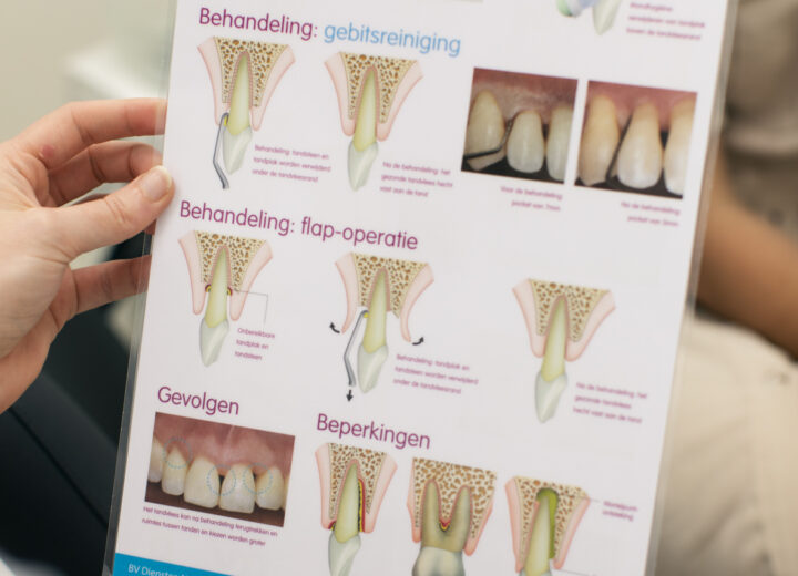 Zes Redenen Waarom Tandenknarsen Slecht Voor Je Is