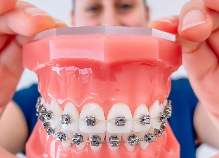 Orthodontie op Latere Leeftijd: Meer dan Alleen Mooie Tanden